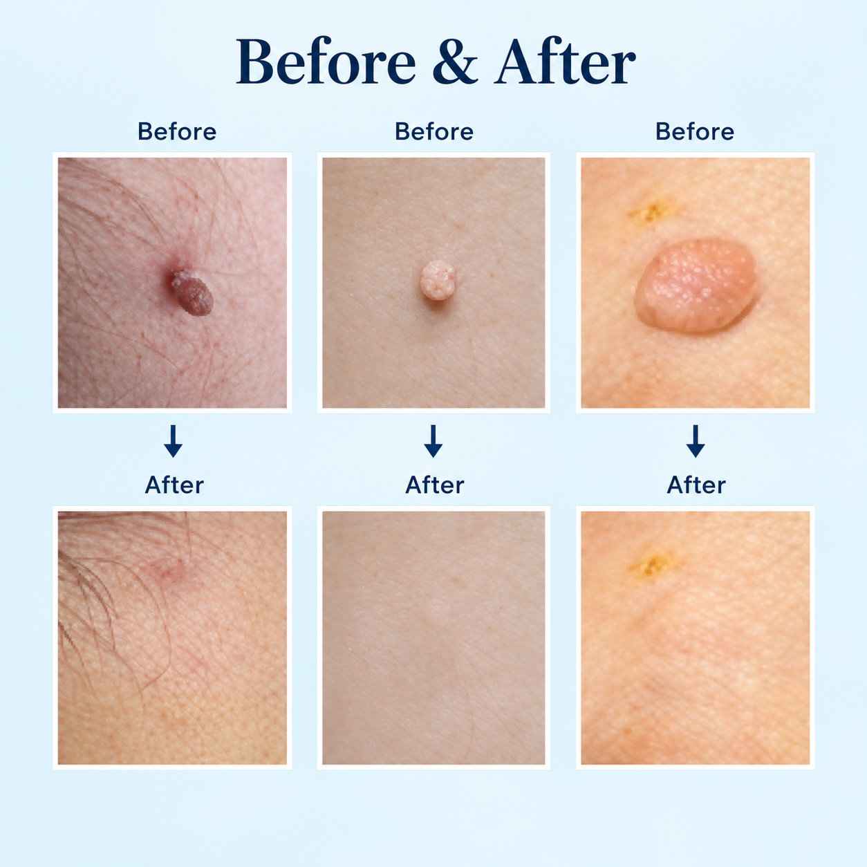 Skin tag removal set