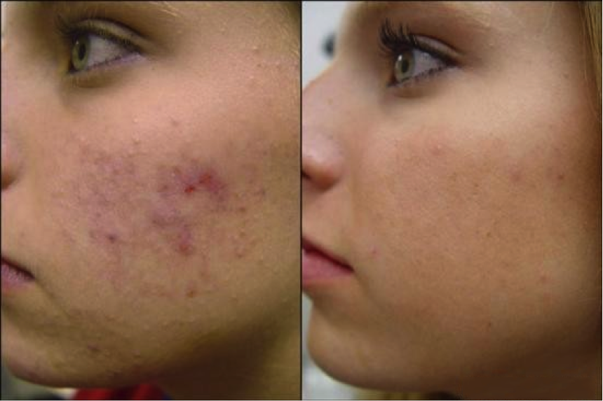 Tresiore microneedle infusion